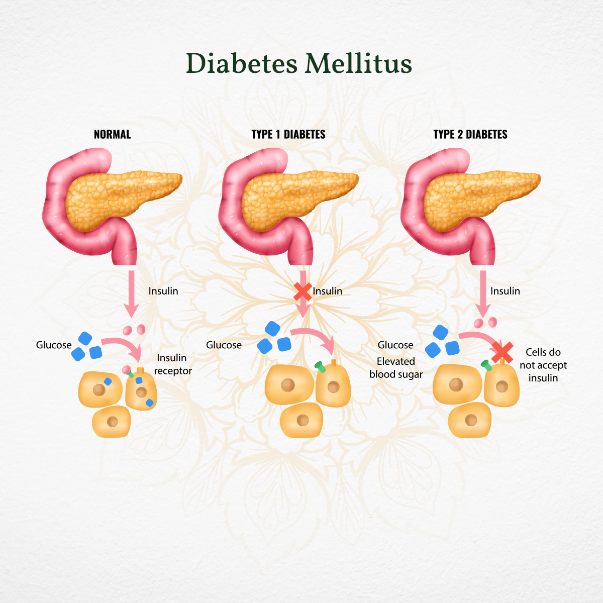 Medical diagram comparing normal pancreas, Type 1 diabetes, and Type 2 diabetes insulin-glucose function with Amrith Noni D Plus reference